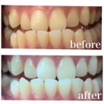 セルフホワイトニング